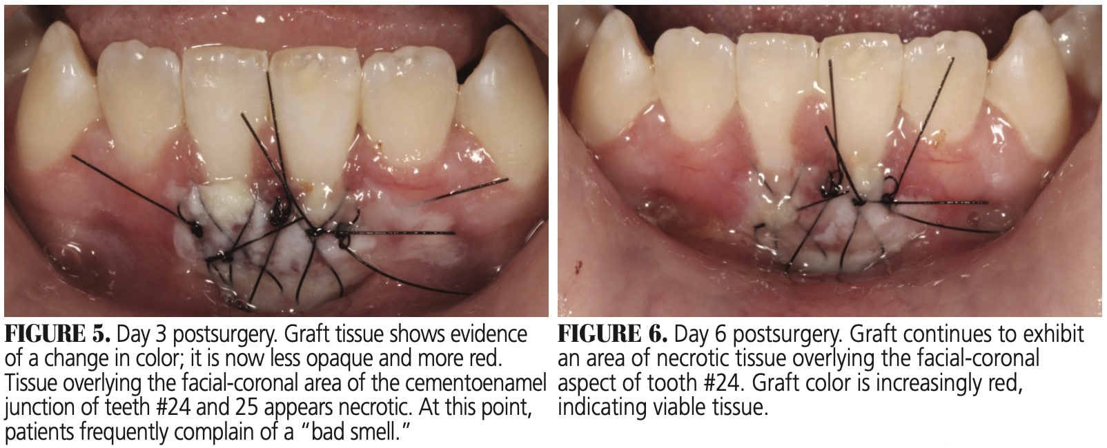 Gingival Graft Before and After: Healing Timeline and Results