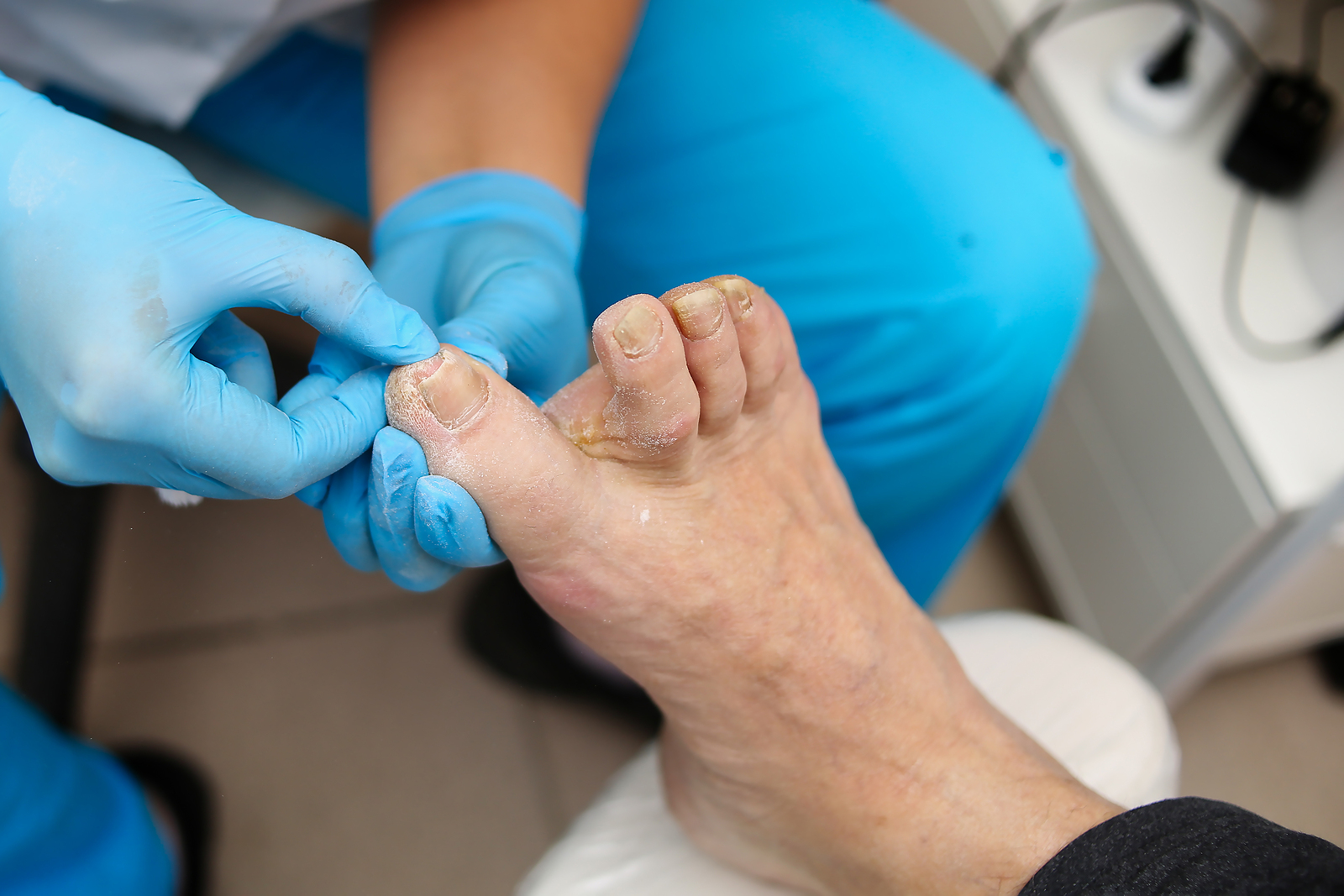 Will an Ingrown Toenail Eventually Grow Out? Treatment Options
