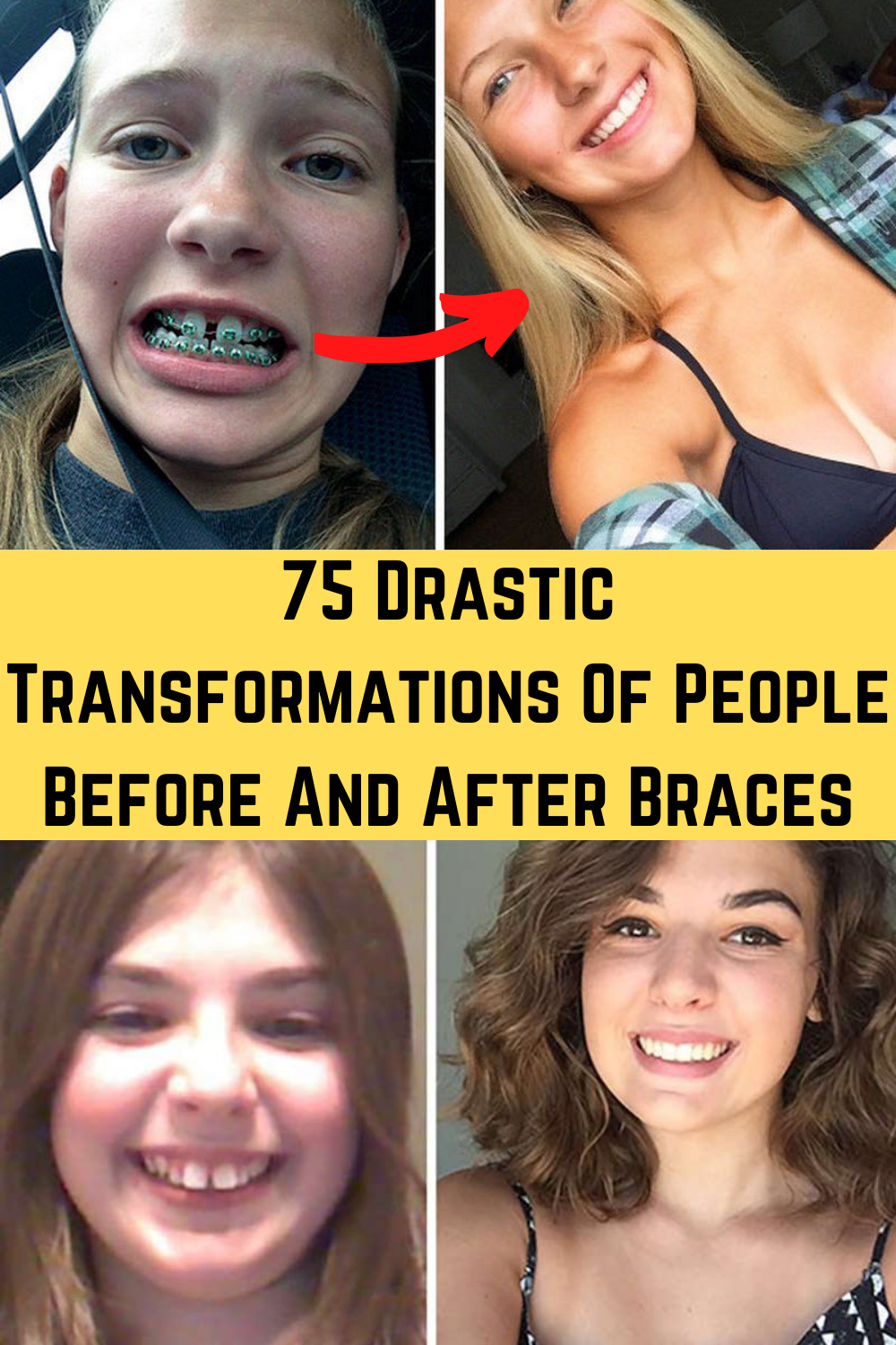 Braces Before and After Images: Real Transformations and Expectations