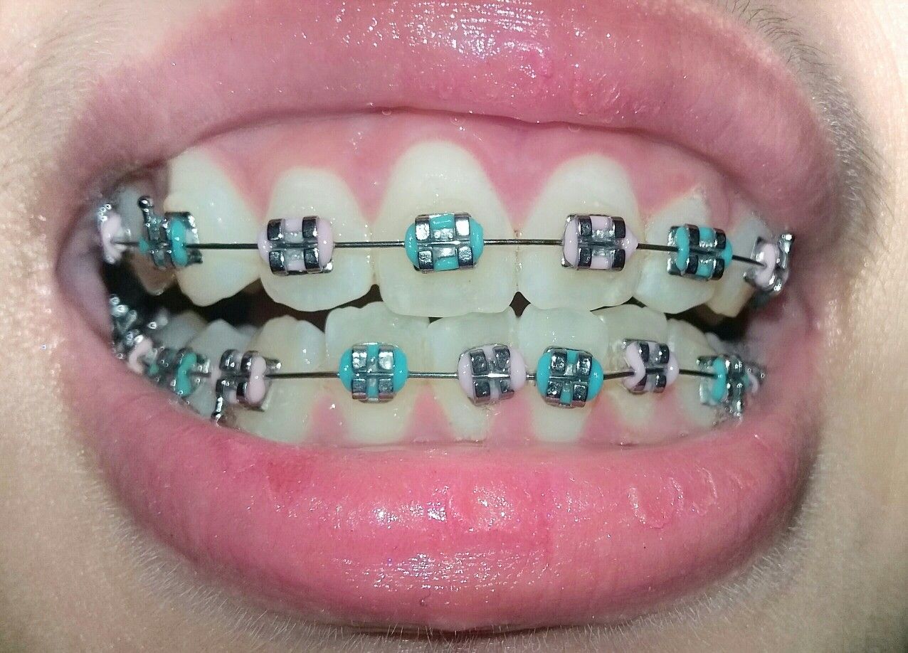 Blue and Light Blue Braces: Color Ideas and Style Inspiration