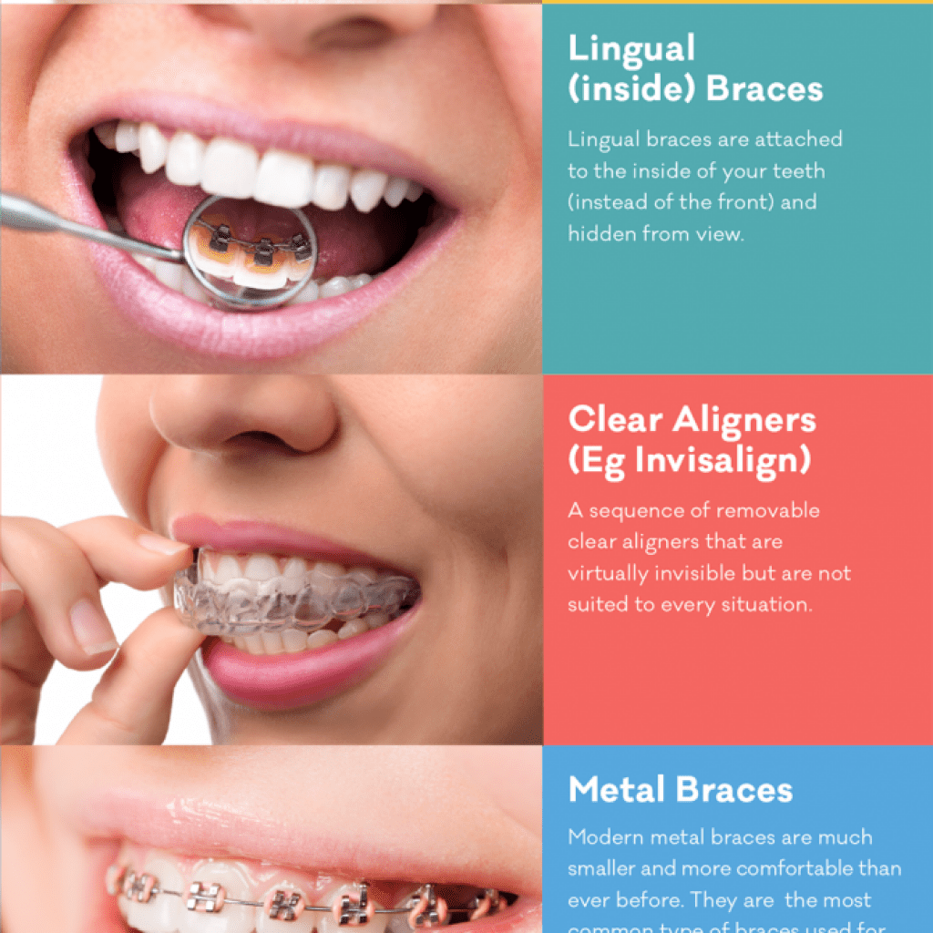 How to Straighten Teeth Without Braces: Safe Alternatives Explained