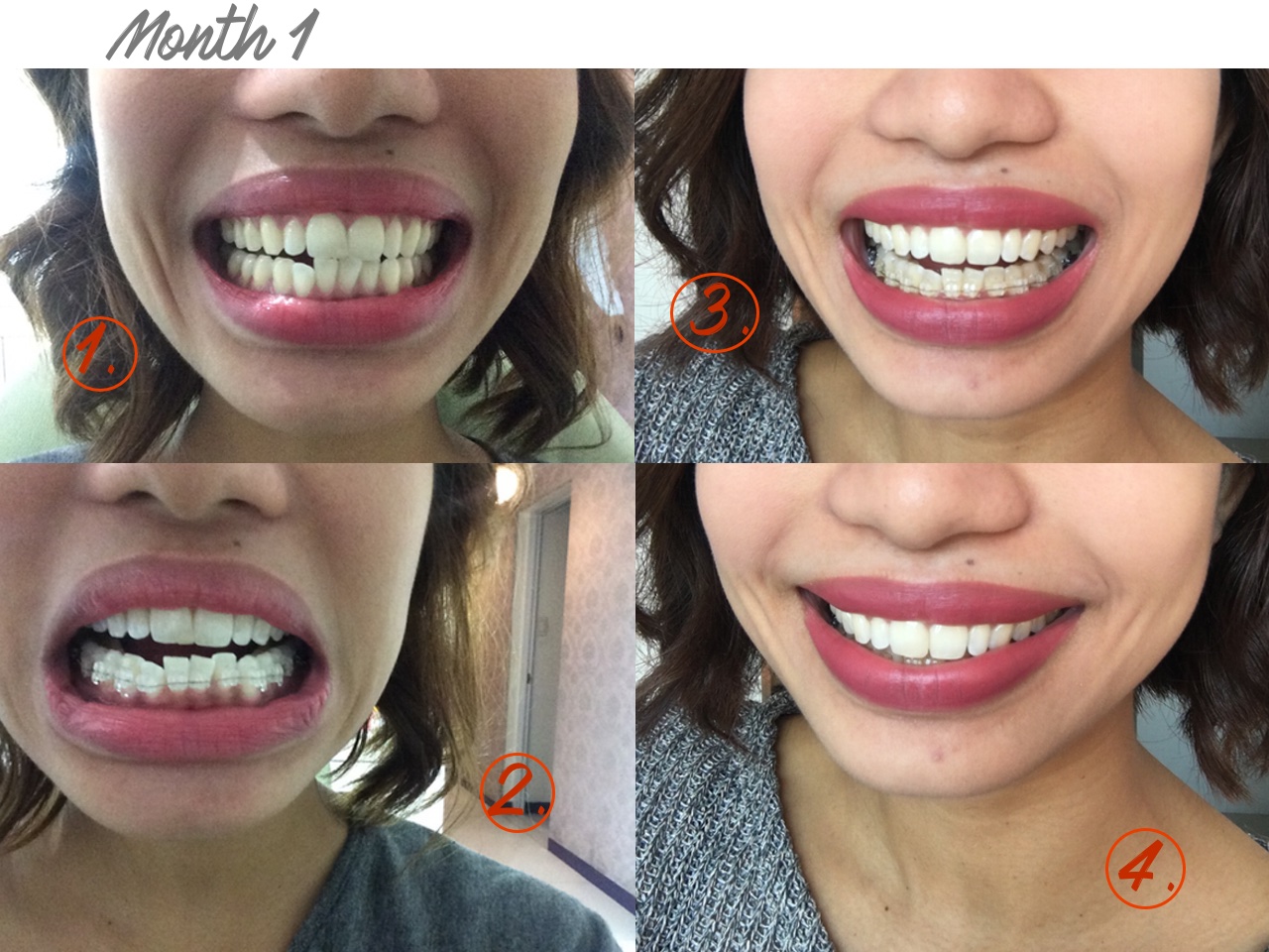 Molar Removal for Braces: Worth the Pain for a Perfect Smile?
