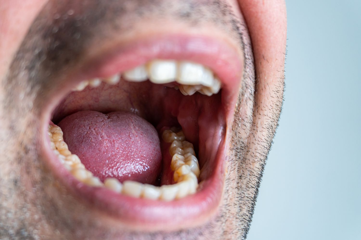 Orange Roof of Mouth: Causes Symptoms and When to See a Doctor