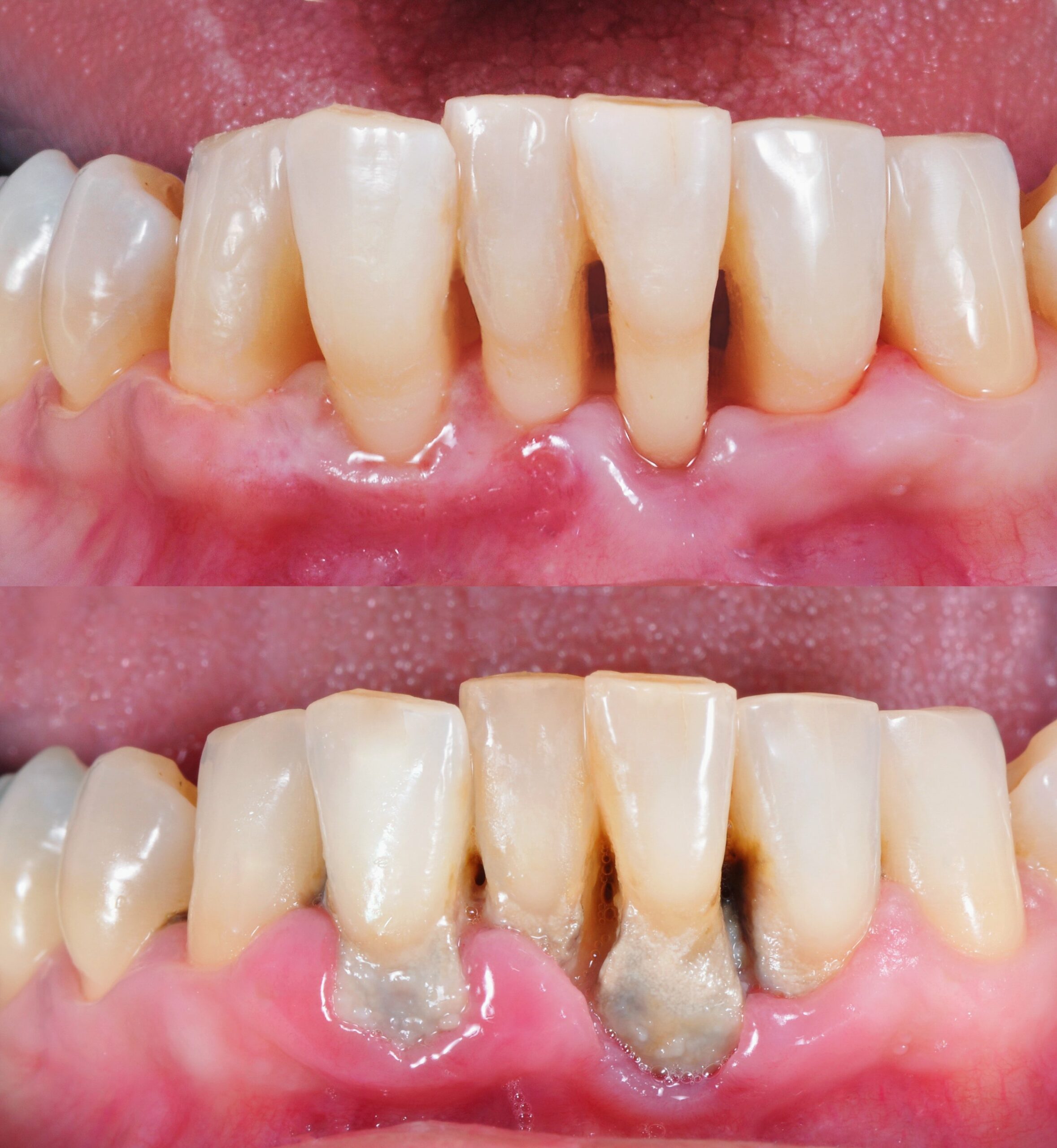 Can a Gum Infection Kill You? Risks Symptoms and When to See a Dentist