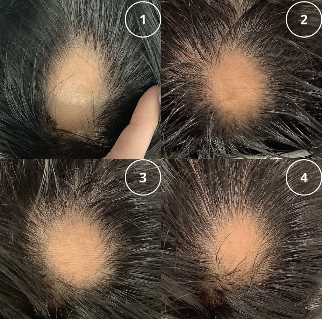 Hairfall Before and After: Real Regrowth Results and Treatments