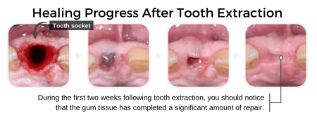 Headache After Molar Extraction: Normal or Time to Call the Dentist?