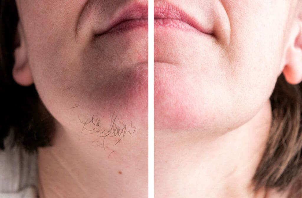 How Many Laser Hair Removal Sessions Do You Need? Results Timeline