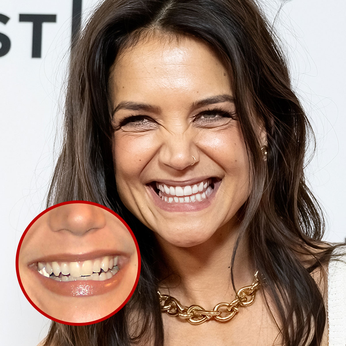 Teeth Veneers Before and After: Real Results and Expectations