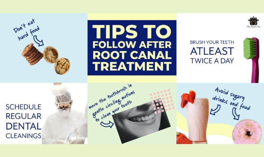 How Long Do Root Canals Last? Longevity and Aftercare Tips
