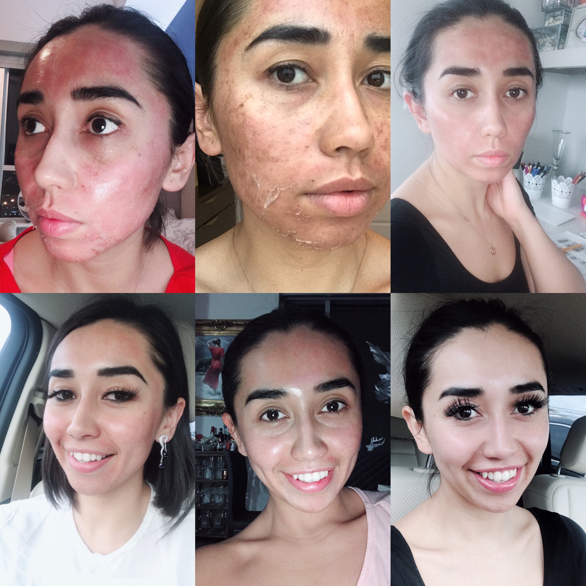 Before and After Laser Hair Removal: Real Results and Expectations