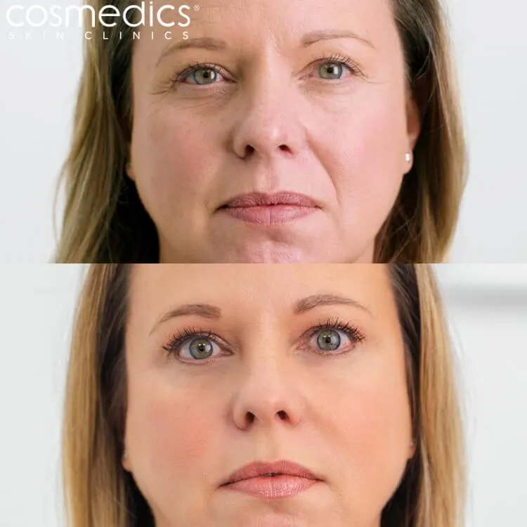 Fillers for Smoker’s Lines: Best Treatments Cost and Results