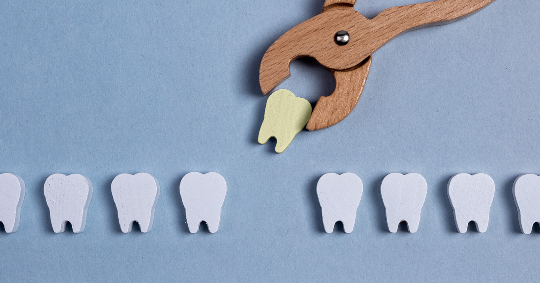 Removing All 4 Wisdom Teeth: Surprising Benefits You Didn’t Expect