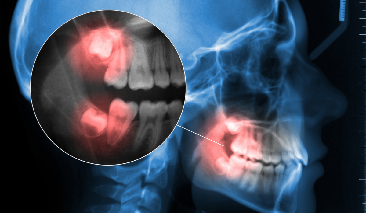 Headaches After Teeth Extractions: Normal Healing or Warning Sign?