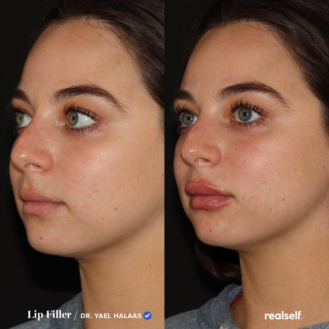 How Long Does It Take for Lip Fillers to Settle? Healing Timeline