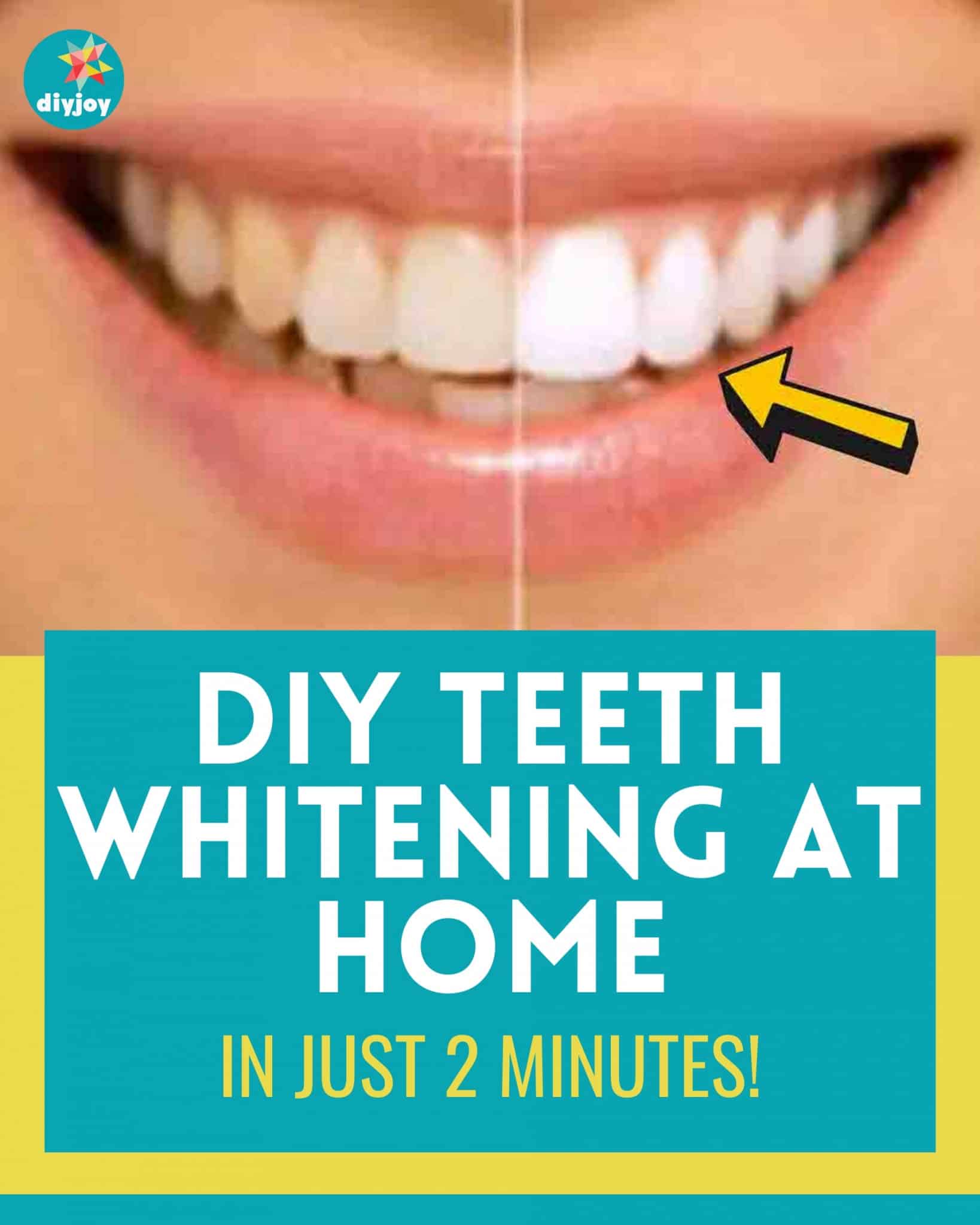 Teeth Whitening Gum Shield: DIY Bright Smile Without the Dentist Bill