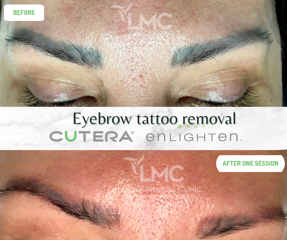 Laser Eyebrow Tattoo Removal Healing Process: Timeline and Aftercare