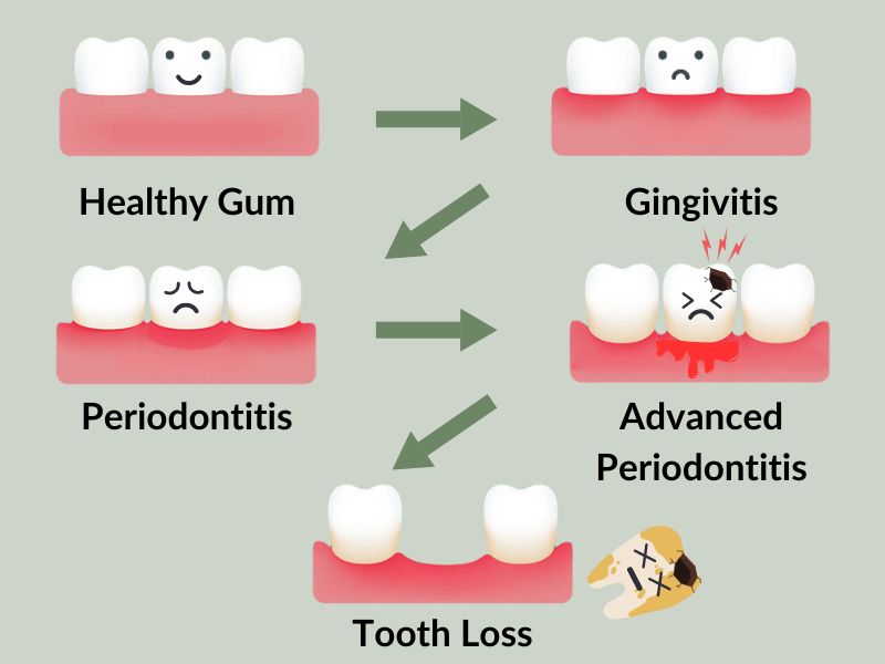 How Far Can Gums Recede Before Teeth Fall Out? Scary Facts and Prevention