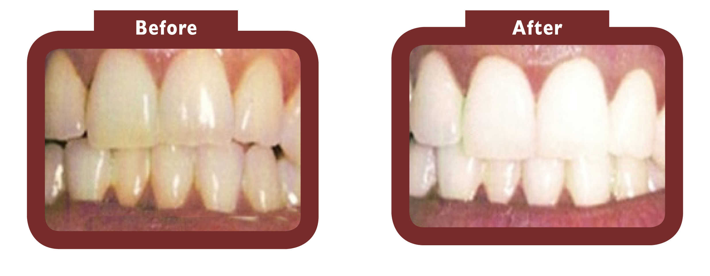 Teeth Whitening Before and After: Results Safety and Expectations