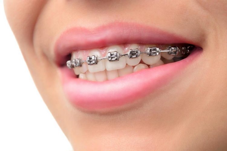 How to Ease Braces Pain: Dentist-Approved Comfort Tips
