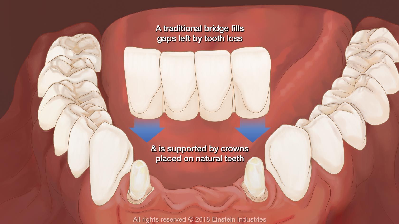 Cost of Bridge Work: Dental Pricing Breakdown and Insurance Tips