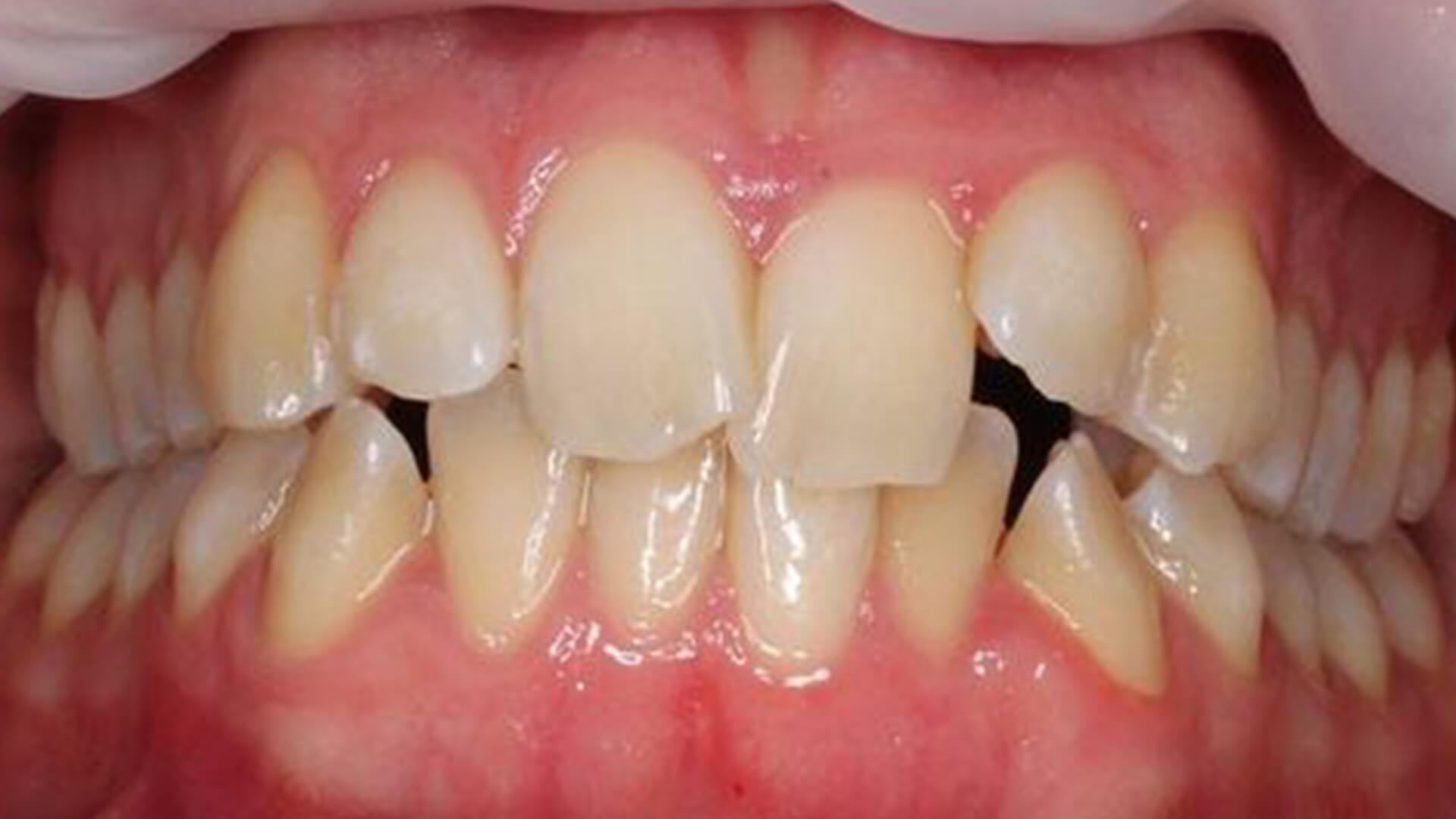 What Causes an Overbite? Surprising Habits Wrecking Your Smile!