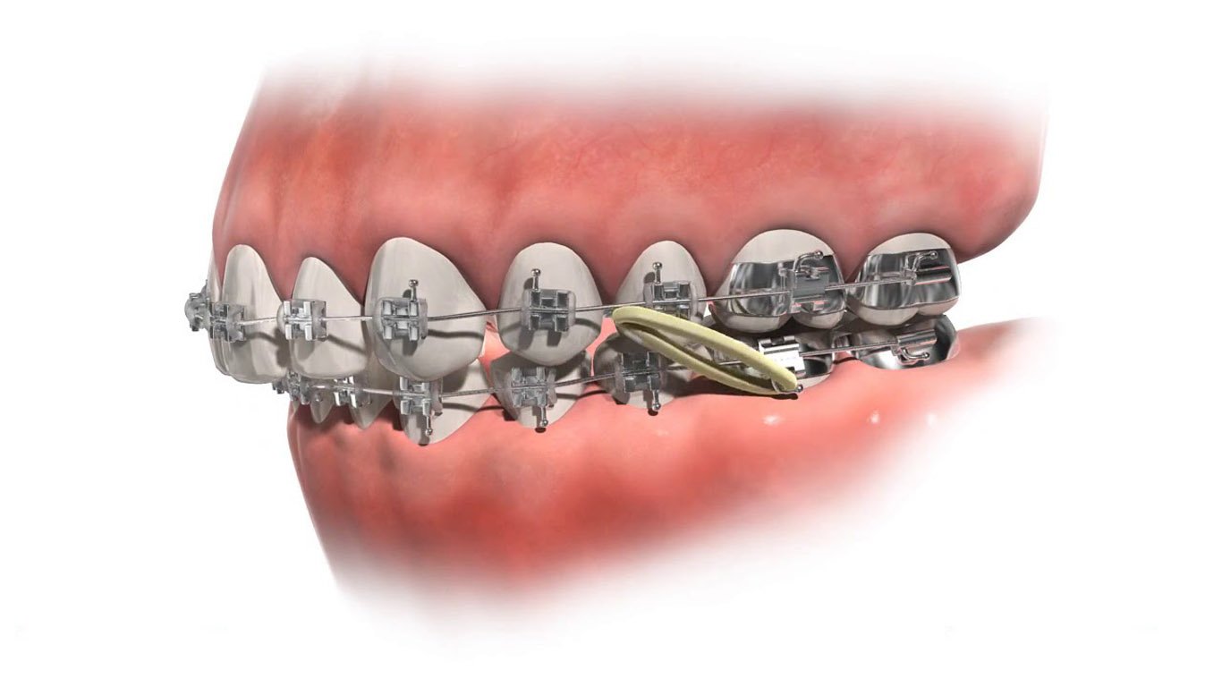 Overbite Before and After: Real Treatment Results and Timelines