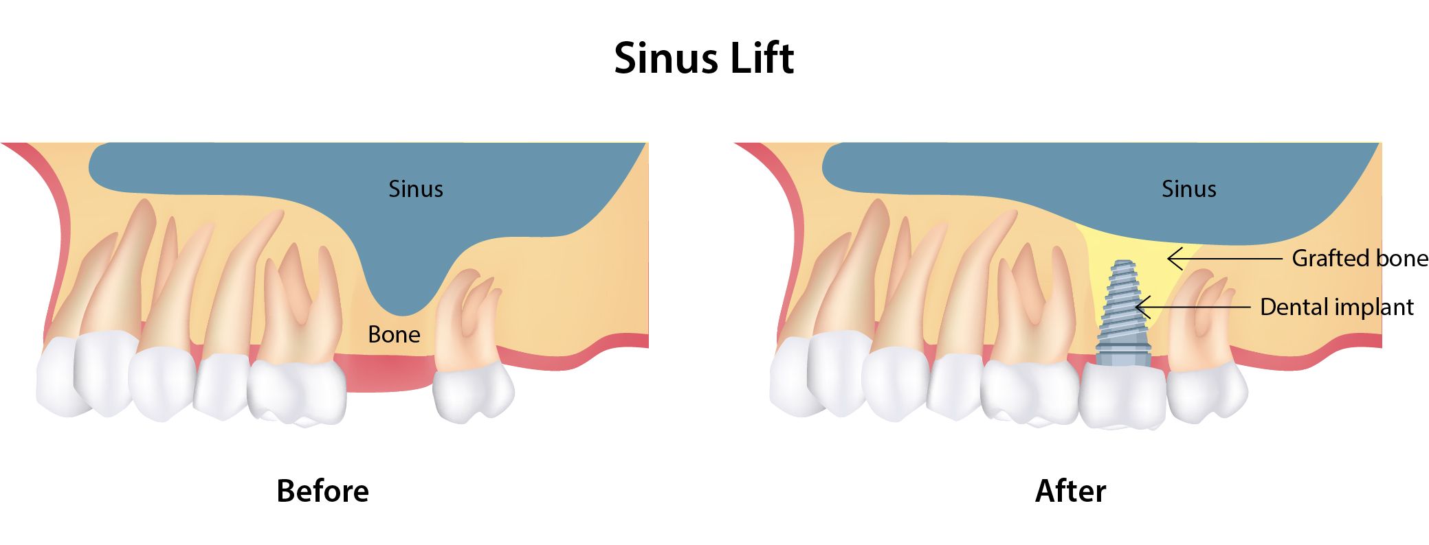 Sinus Lift Before and After Face: Real Changes and What to Expect