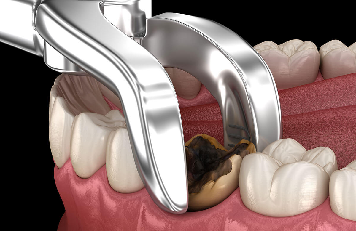 Cost to Pull a Tooth: Price Guide and What Affects It